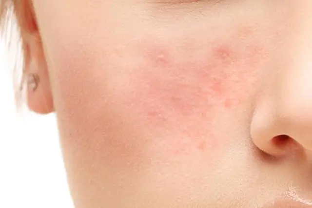 autoimmune-disease